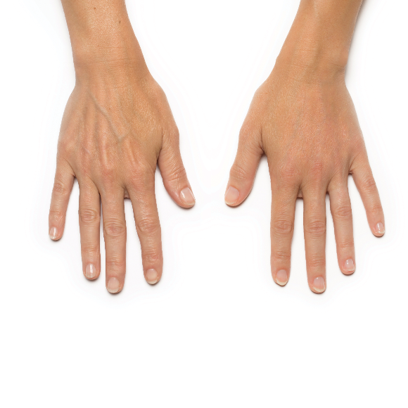 Before and after comparison of two hands. The “before” hand on the left has more veins and tendons. The “after” hand on the right is fuller.
